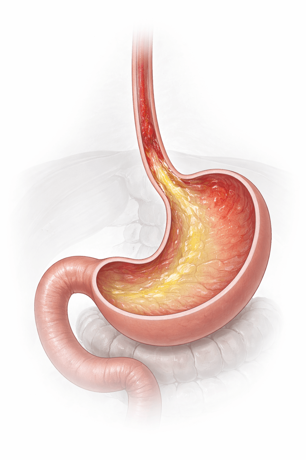 DRGE (Doença do Refluxo Gastroesofágico)